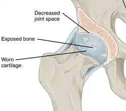 Annotated illustration of hip joint with ostoarthritis