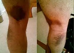 إجهاد أدى لتمزق عضلي. إذا لم يعالج الشد العضلي فقد ينتج عنه تمزق عضلي