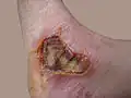 اليوم الثامن لحرق من الدرجة الثالثة بسبب كاتم صوت دراجة نارية.