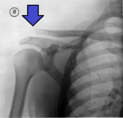 An Xray showing a separated shoulder. Notice the separation between the end of the ترقوة and the عظم الكتف.