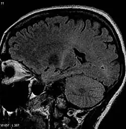 This MRI (parasagittal استعادة السائل الموهن بالانقلاب) demonstrates increased T2 signal within the posterior part of the محفظة غائرة and can be tracked to the subcortical white matter of the قشرة حركية, outlining the سبيل قشري نخاعي, consistent with the clinical diagnosis of ALS..mw-parser-output cite.citation{font-style:inherit;word-wrap:break-word}.mw-parser-output .citation q{quotes:"\"""\"""'""'"}.mw-parser-output .citation:target{background-color:rgba(0,127,255,0.133)}.mw-parser-output .id-lock-free.id-lock-free a{background:url("//upload.wikimedia.org/wikipedia/commons/6/65/Lock-green.svg")right 0.1em center/9px no-repeat}.mw-parser-output .id-lock-limited.id-lock-limited a,.mw-parser-output .id-lock-registration.id-lock-registration a{background:url("//upload.wikimedia.org/wikipedia/commons/d/d6/Lock-gray-alt-2.svg")right 0.1em center/9px no-repeat}.mw-parser-output .id-lock-subscription.id-lock-subscription a{background:url("//upload.wikimedia.org/wikipedia/commons/a/aa/Lock-red-alt-2.svg")right 0.1em center/9px no-repeat}.mw-parser-output .cs1-ws-icon a{background:url("//upload.wikimedia.org/wikipedia/commons/4/4c/Wikisource-logo.svg")left 0.1em center/12px no-repeat}body:not(.skin-timeless):not(.skin-minerva) .mw-parser-output .id-lock-free a,body:not(.skin-timeless):not(.skin-minerva) .mw-parser-output .id-lock-limited a,body:not(.skin-timeless):not(.skin-minerva) .mw-parser-output .id-lock-registration a,body:not(.skin-timeless):not(.skin-minerva) .mw-parser-output .id-lock-subscription a,body:not(.skin-timeless):not(.skin-minerva) .mw-parser-output .cs1-ws-icon a{background-size:contain;padding:0 1em 0 0}.mw-parser-output .cs1-code{color:inherit;background:inherit;border:none;padding:inherit}.mw-parser-output .cs1-hidden-error{display:none;color:var(--color-error,#d33)}.mw-parser-output .cs1-visible-error{color:var(--color-error,#d33)}.mw-parser-output .cs1-maint{display:none;color:#085;margin-left:0.3em}.mw-parser-output .cs1-kern-left{padding-left:0.2em}.mw-parser-output .cs1-kern-right{padding-right:0.2em}.mw-parser-output .citation .mw-selflink{font-weight:inherit}@media screen{.mw-parser-output .cs1-format{font-size:95%}html.skin-theme-clientpref-night .mw-parser-output .cs1-maint{color:#18911f}}@media screen and (prefers-color-scheme:dark){html.skin-theme-clientpref-os .mw-parser-output .cs1-maint{color:#18911f}}"Motor Neuron Diseases Fact Sheet". المعهد الوطني للاضطرابات العصبية والسكتة الدماغية. مؤرشف من الأصل في 13 أبريل 2014. اطلع عليه بتاريخ 7 نوفمبر 2010..mw-parser-output cite.citation{font-style:inherit;word-wrap:break-word}.mw-parser-output .citation q{quotes:"\"""\"""'""'"}.mw-parser-output .citation:target{background-color:rgba(0,127,255,0.133)}.mw-parser-output .id-lock-free.id-lock-free a{background:url("//upload.wikimedia.org/wikipedia/commons/6/65/Lock-green.svg")right 0.1em center/9px no-repeat}.mw-parser-output .id-lock-limited.id-lock-limited a,.mw-parser-output .id-lock-registration.id-lock-registration a{background:url("//upload.wikimedia.org/wikipedia/commons/d/d6/Lock-gray-alt-2.svg")right 0.1em center/9px no-repeat}.mw-parser-output .id-lock-subscription.id-lock-subscription a{background:url("//upload.wikimedia.org/wikipedia/commons/a/aa/Lock-red-alt-2.svg")right 0.1em center/9px no-repeat}.mw-parser-output .cs1-ws-icon a{background:url("//upload.wikimedia.org/wikipedia/commons/4/4c/Wikisource-logo.svg")left 0.1em center/12px no-repeat}body:not(.skin-timeless):not(.skin-minerva) .mw-parser-output .id-lock-free a,body:not(.skin-timeless):not(.skin-minerva) .mw-parser-output .id-lock-limited a,body:not(.skin-timeless):not(.skin-minerva) .mw-parser-output .id-lock-registration a,body:not(.skin-timeless):not(.skin-minerva) .mw-parser-output .id-lock-subscription a,body:not(.skin-timeless):not(.skin-minerva) .mw-parser-output .cs1-ws-icon a{background-size:contain;padding:0 1em 0 0}.mw-parser-output .cs1-code{color:inherit;background:inherit;border:none;padding:inherit}.mw-parser-output .cs1-hidden-error{display:none;color:var(--color-error,#d33)}.mw-parser-output .cs1-visible-error{color:var(--color-error,#d33)}.mw-parser-output .cs1-maint{display:none;color:#085;margin-left:0.3em}.mw-parser-output .cs1-kern-left{padding-left:0.2em}.mw-parser-output .cs1-kern-right{padding-right:0.2em}.mw-parser-output .citation .mw-selflink{font-weight:inherit}@media screen{.mw-parser-output .cs1-format{font-size:95%}html.skin-theme-clientpref-night .mw-parser-output .cs1-maint{color:#18911f}}@media screen and (prefers-color-scheme:dark){html.skin-theme-clientpref-os .mw-parser-output .cs1-maint{color:#18911f}}Zarei S، Carr K، Reiley L، Diaz K، Guerra O، Altamirano PF، وآخرون (16 نوفمبر 2015). "A comprehensive review of amyotrophic lateral sclerosis". Surgical Neurology International. ج. 6: 171. DOI:10.4103/2152-7806.169561. PMC:4653353. PMID:26629397.{{استشهاد بدورية محكمة}}: صيانة الاستشهاد: دوي مجاني غير معلم (link)
