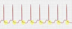 An example of an ECG tracing typical of uncommon AV nodal reentrant tachycardia. Highlighted in yellow is the P wave that falls after the QRS complex.
