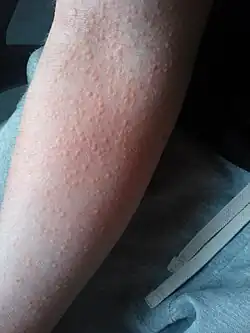 شرى كوليني على الجانب الراحي للساعد