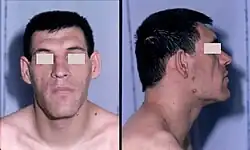 ضخامة الأطراف