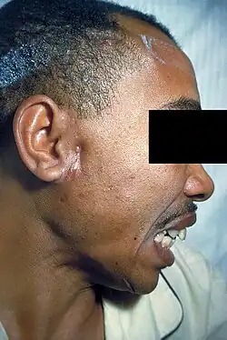 رجل مع داء الشعيات على طرف وجهه الأيمن