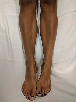 سواد الجلد الذي يظهر على أرجل مريض يعاني من زيادة الميلانين.