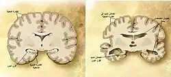 مقارنةٌ بين دماغٍ سليم في مرحلة الشيخوخة (اليسار) ودماغٍ لشخصٍ مصابٍ بآلزهايمر (اليمين). تظهرُ الفروقات بين الدماغين على الصُورة.