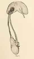رسم من عام 1909م لحالب ليس مكررًا تمامًا، حيث يتداخل جزء من نهايات الحالب البعيدة ويمتد إلى مدخل المثانة وينتهي في حويصلة حالبية واحدة. منظر بطني رُسم من عينة في معهد براغ الباثولوجي.