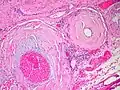 داء نشواني، وعاء دموي (بالإنجليزية: Amyloidosis, blood vessels, H&E)