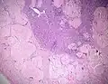 داء نشواني، عقدة لمفاوية (بالإنجليزية: Amyloidosis, lymph node, H&E