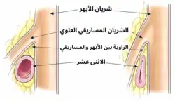 على اليسار يظهر الاثنى عشر بشكلٍ طبيعي، يمر بين الشريان المساريقي العلوي والشريان الأبهر. أما على اليمين فيظهر أن الاثنى عشر تعرض إلى الإنضغاط والانسداد، وهذا ما يُسمّى بـ متلازمة الشريان المساريقي العلوي.