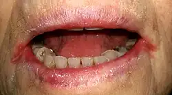 التهاب الشفة الزاوي ثنائي الجانب لدى شخص كبير السن (كهل) لديه سن مستعار مع فقر الدم الناجم عن نقص الحديد إلى جانب جفاف الفم.
