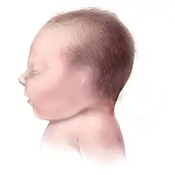 رسم توضيحي لانعدام الأذن