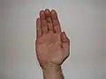تشوه يد القرد يحدث نتيجة إصابات في العصب المتوسط والعصب الزندي.