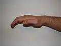 تشوه يد القرد.