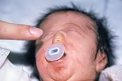 طفل حديث الولادة به انعدام أنف جزئي (بالإنجليزية: partial arhinia).