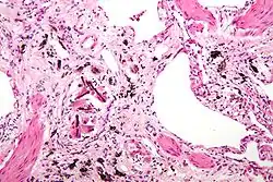صورة مكبرة عن السحار الاسبست( مع وجود أجسام حديدية)، وهو نوع من تغبر الرئة. صبغة H&E.