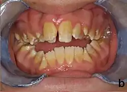 عيب التخليق النوع نقص التنسج، لاحظ ارتباط المينا المرقط والإطباق المفتوح.