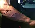 الوريد البازلي على ساعد ذكر بالغ.