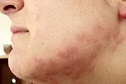 عضات بق الفراش الشهيرة.