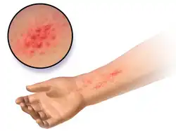 التهاب الجلد التحسسي كرد فعل للمعادن