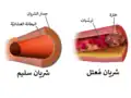 رسم توضيحي لمقارنة شريان سليم مقابل شريان مريض بتجلط الدم (التخثر).