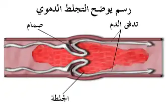 مخطط تخثر الدم
