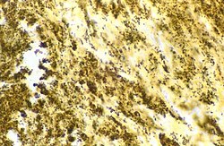 Bartonella henselae bacilli in cardiac valve of a patient with blood culture-negative endocarditis. The bacilli appear as black granulations.