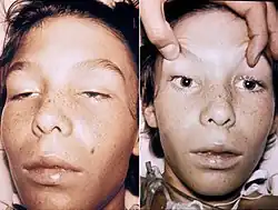شاب عمره 14 عاماً، مصاب بالتسمم الغذائي. لاحظ شلل العين الكلي الثنائي مع إطراق في الصورة  اليسرى وتوسع البؤبؤ وثباته في الصورة اليمنى. هذا الشاب كان بكامل وعيه لحظة التقاط الصورة.