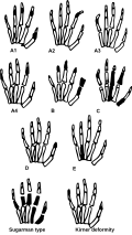 أنواع قصر الأصابع