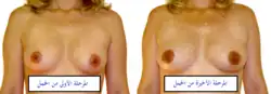 من الطبيعي أن يزداد حجم الثدي خلال فترة الحمل