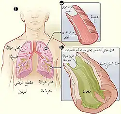صورة مقطعية للرئة تظهر فيها القصبات الهوائية الطبيعية والمتوسعة. الشكل (ب) تظهر فيه صورة مقطعية لقصبة هوائية طبيعية. الشكل (ج) تظهر فيه صورة مقطعية لقصبة مصابة بتوسع القصبات.