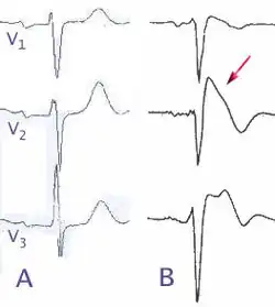 A) تخطيط طبيعي لكهربائية القلب
B) متغيرات تخطيط كهربائية القلب في متلازمة بروغادا