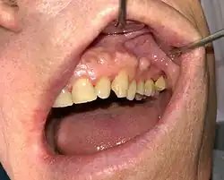 عرن شدقي على طول الجزء العلوي من الحرف السنخي الأيسر