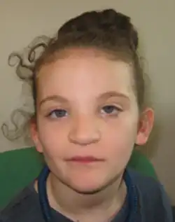 Typical facial appearance of an individual with CDK13-related disorder