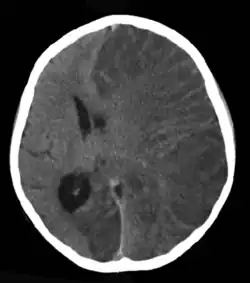 Brain CT scan of a girl with Rasmussen's encephalitis.