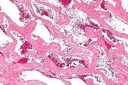 صورة مجهرية of a cavernous كبد hemangioma. صبغة الهيماتوكسيلين واليوزين.