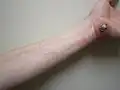 التهاب الهلل حدث تلو سحجة للجلد. لاحظ الخطوط الحمراء لأعلى الساعد والتي تدل على اكتناف الجهاز اللمفاوي .
