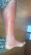 التهاب الهلل في الساق مع اكتناف القدم.