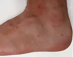 لدغة القذذ في القدم