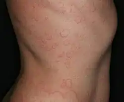 مظهر الشرى التلقائي المزمن