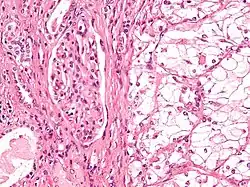 صورة مجهرية showing the most common type of kidney cancer (clear cell سرطانة الخلية الكلوية). H&E stain.