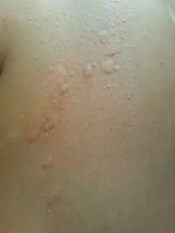 شرى في الساق بسبب البرد.