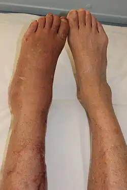 متلازمة الألم الناحي المركب