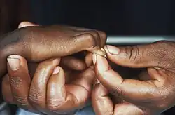 صورة توضح شكل متلازمة دوبوا في الخنصر