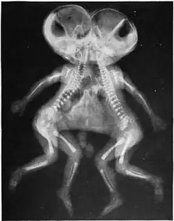 X-ray of joined twins, cephalothoracopagus.