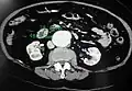 A transverse contrast enhanced CT scan demonstrating an abdominal aortic aneurysm of 4.8 by 3.8&nbsp;cm