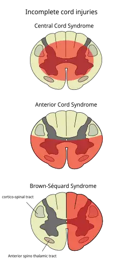 Central cord syndrome is top diagram