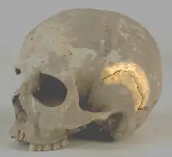 منظر جانبي لقحف الدرز الصدغي مسلط عليه الضؤ.