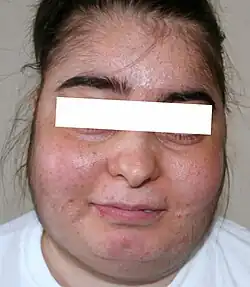 وجه بدري ناتج عن استعمال الستيرويدات
